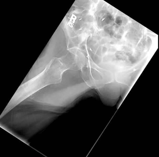 File:Occult hip fracture 002.jpg