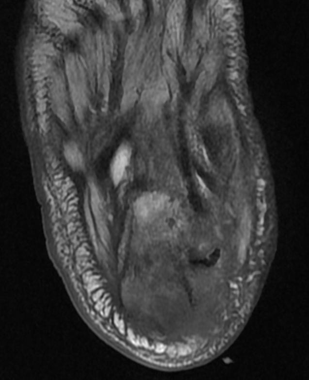 File:Osteomyelitis MRI 003.jpg