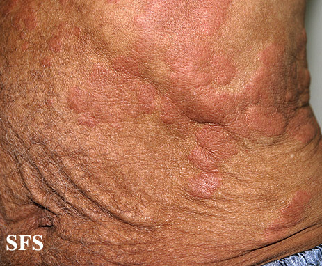 Well's syndrome. Adapted from Dermatology Atlas.[4]