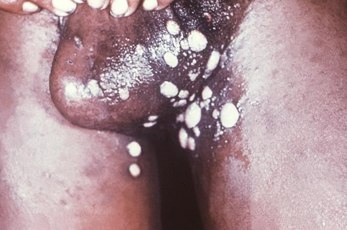 This image depicts the perineal region of a male patient, who’d presented with what was described as eroded, moist, papular intertrigo, due to what was diagnosed as a case of secondary syphilis. Intertrigo is an inflamed area of a skin fold where two skin surfaces touch one another, such as here, in the gluteal cleft between the buttocks. The secondary stage of syphilis is characterized by the manifestation of a skin rash and mucous membrane lesions. This stage typically starts with the development of a rash on one or more areas of the body. The rash usually does not cause itching. Rashes associated with secondary syphilis can appear as the chancre is healing or several weeks after the chancre has healed. The characteristic rash of secondary syphilis may appear as rough, red, or reddish brown spots both on the palms of the hands and the bottoms of the feet. However, rashes with a different appearance may occur on other parts of the body, sometimes resembling rashes caused by other diseases. Sometimes rashes associated with secondary syphilis are so faint that they are not noticed. In addition to rashes, symptoms of secondary syphilis may include fever, swollen lymph glands, sore throat, patchy hair loss, headaches, weight loss, muscle aches, and fatigue. The signs and symptoms of secondary syphilis will resolve with or without treatment, but without treatment, the infection will progress to the latent and possibly late stages of disease. Adapted from CDC