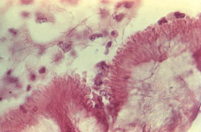 Actinomycosis. From Public Health Image Library (PHIL). [3]