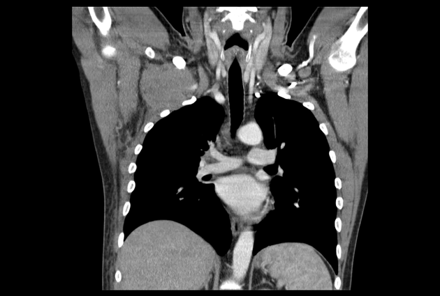 File:Anaplastic large cell lymphoma CT scan .png