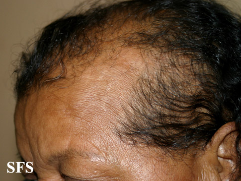File:Androgenetic alopecia 02.jpeg