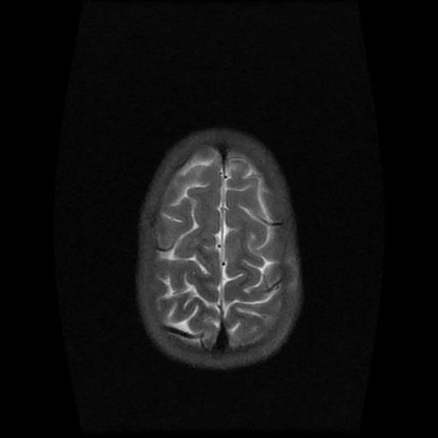 Carvarial mass lesion in the right occipital region which extends internally and seems to breach the dura.[2]