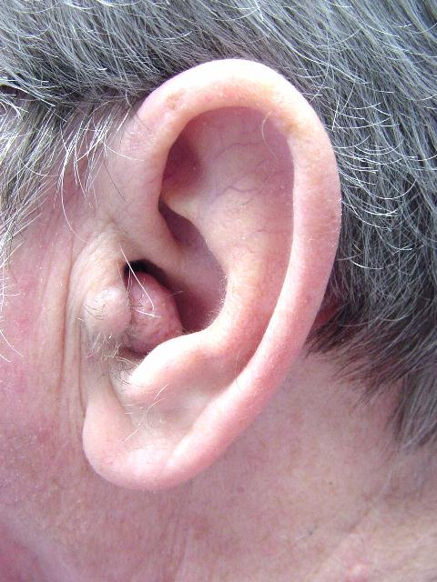 Large cyst of the external auditory meatus. [3]