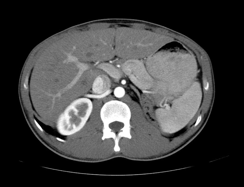 File:Ectopic kidney 001.jpg