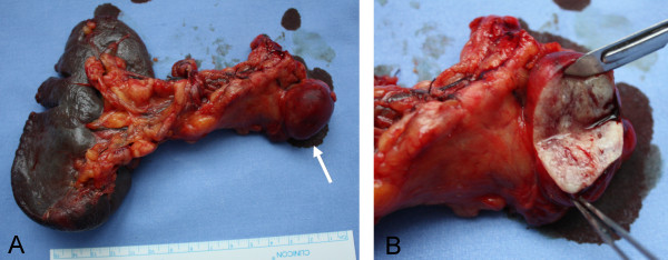 Specimen from distal splenopancreatectomy.A) The neoplasia is located in the inferior border of the pancreas (arrow); it shows an exophytic growth but appears well circumscribed. B) The cut surface is whitish-yellow in color with focal areas of hemorrhage.[11]