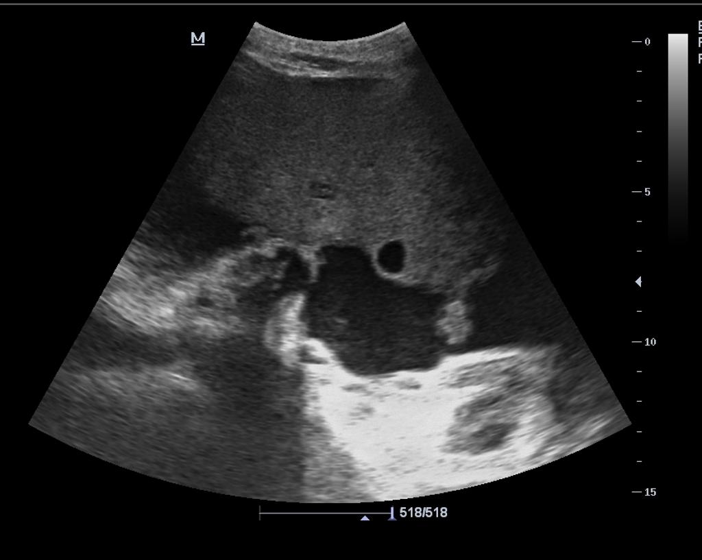 Large, solid, well defined bilateral ovarian masses[10]