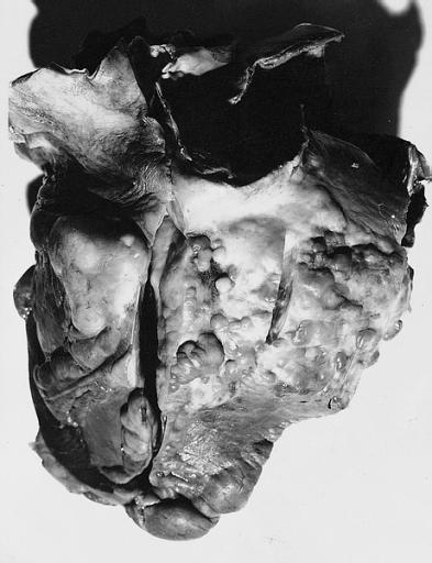 Liposarcoma, Heart: Gross specimen demonstrates the posterior wall of the heart studded with multiple epicardial nodules over the right and left ventricles.