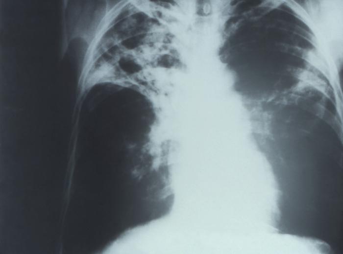 Bilateral Pulmonary Tuberculosis