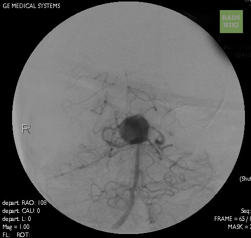 Angiography: A large basilar artery aneurysm