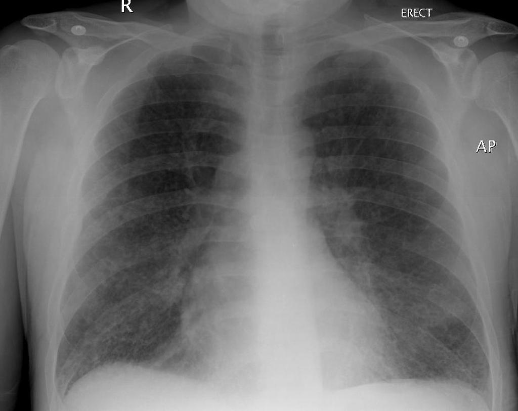 Chest X-ray of Langerhans cell histiocytosis