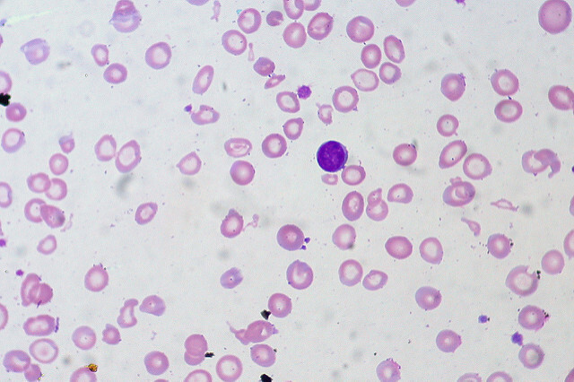 File:Anemia Reticulocyte red blood cell.jpeg