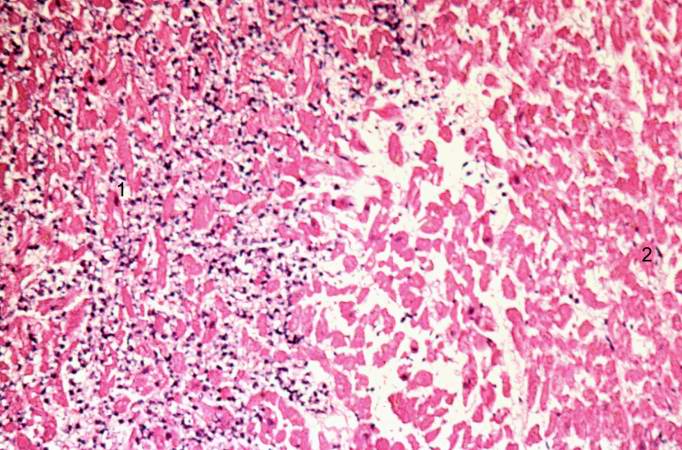 This is a higher-power photomicrograph of the edge of the infarct. The accumulation of inflammatory cells is on the left (1) and the infarcted tissue is on the right (2). Note that intact cells can be seen in the infarct but there are no nuclei.