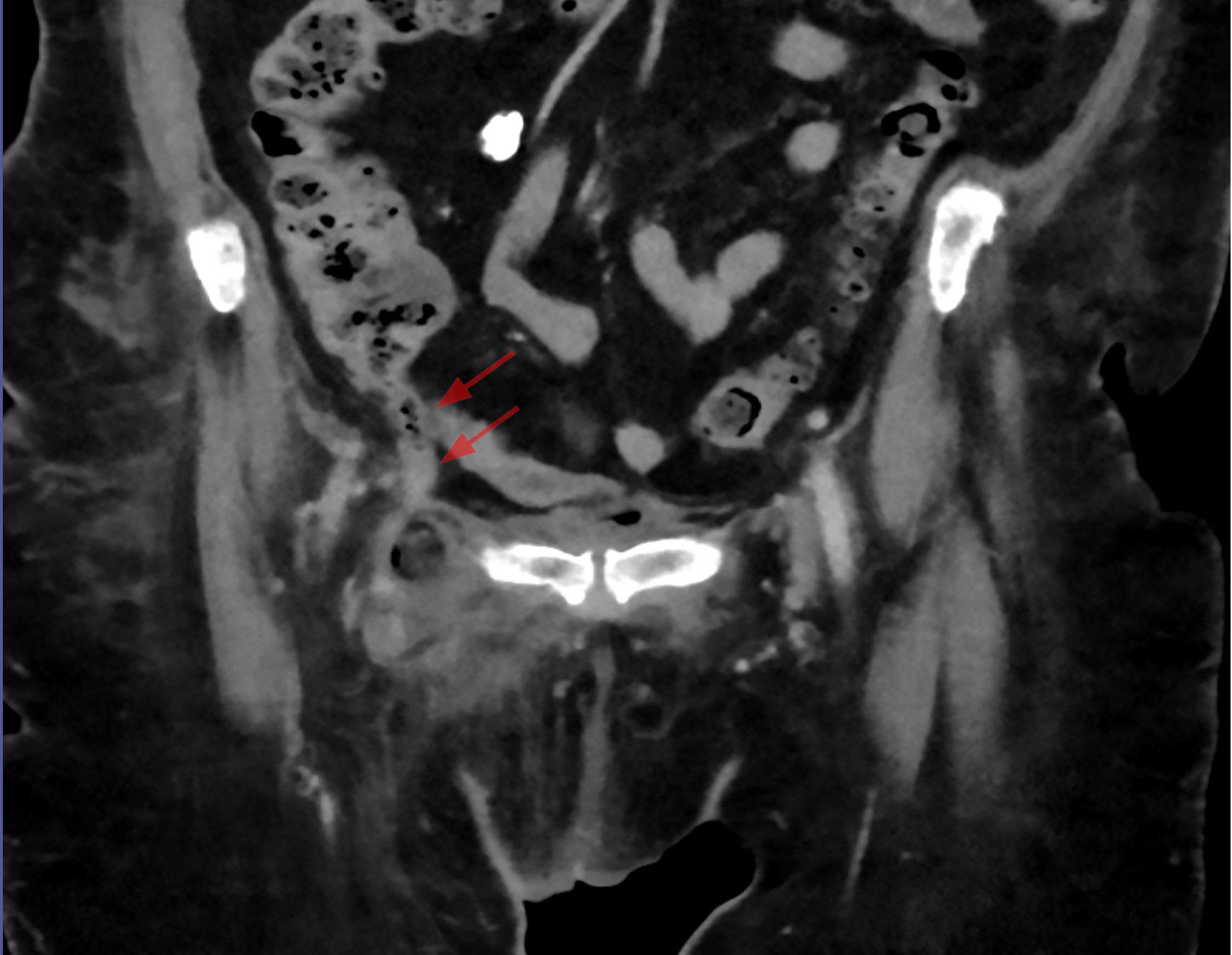 File:De Garengeot-Hernie mit Appendizitis - CT axial und coronar - 001.jpg