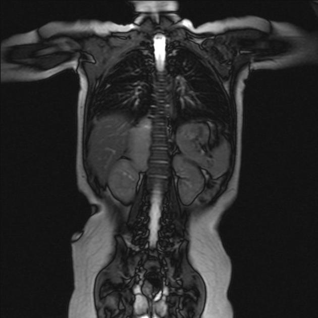 Neuroblastoma observed on coronal MRI of the abdomen as a well defined mass lesion in right suprarenal region[1]