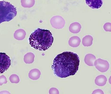 File:Mast cell leukemia peripheral blood smear.jpg