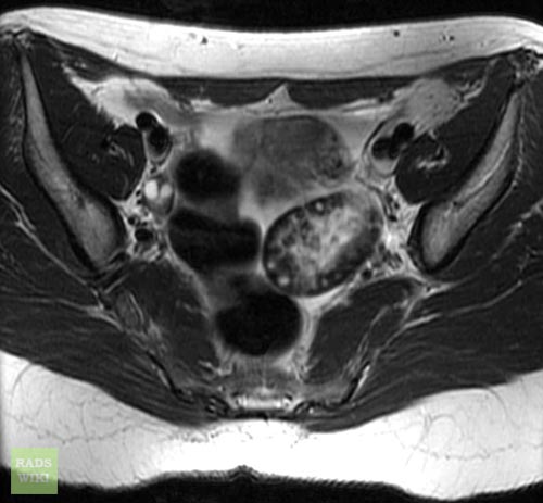 Coronal T2 patient#1 Image courtesy of RadsWiki and copylefted