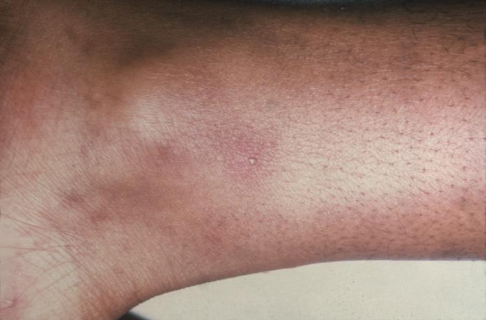 This patient presented with gonorrhea and a disseminated gonococcal skin infection about the ankle. Gonorrhea, caused by Neisseria gonorrhoeae, if left untreated will enter the blood, thereby, spreading throughout the body. As is shown here, such full body dissemination may manifest itself as skin lesions throughout the body.Adapted from CDC
