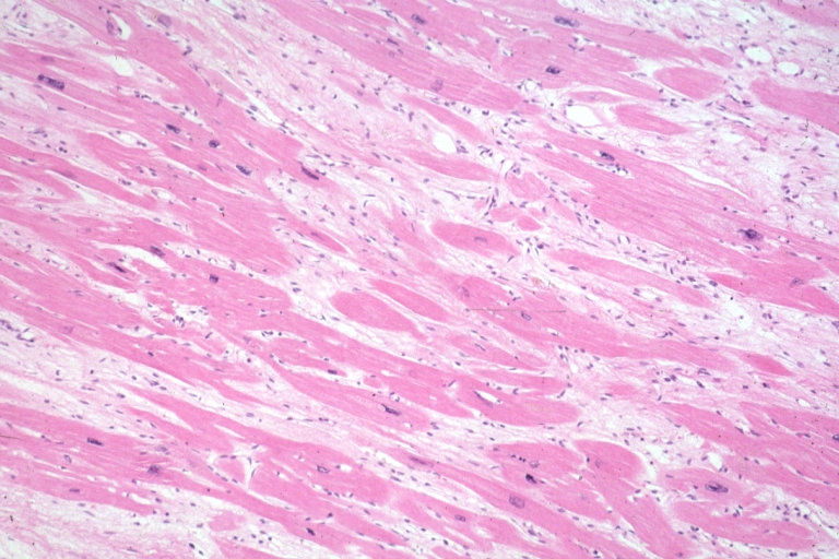 Micro med mag H&E mid-mural myocardium with hypertrophy and interstitial fibrosis atrophy is present marked increase in interstitial fibroblastic cells