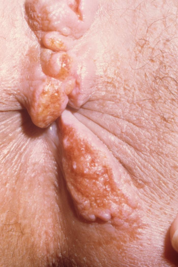 This 19 year old woman presented with an perianal granuloma inguinale lesion of about 8 months duration. From Public Health Image Library (PHIL). [4]
