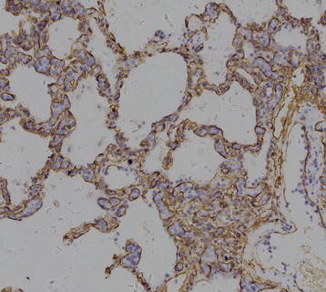 CD34 immunostain shows the neoplastic lymphocytes located in the alveolar capillaries,(200X).[2]