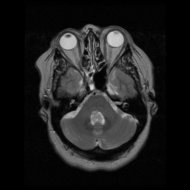 Axial T2-weighted MRI image demonstrates a 17 x 16 x 17 mm hyperintense mass within the floor of the fourth ventricle. No extension into the foramen of Luschka is observed.[17]