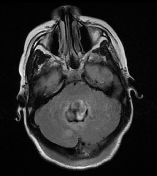 Coronal MRI section of medulloblastoma[1]