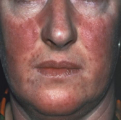 Face psoriasis, courtesy https://aloeworldnorfolk.wordpress.com/tag/psoriasis/