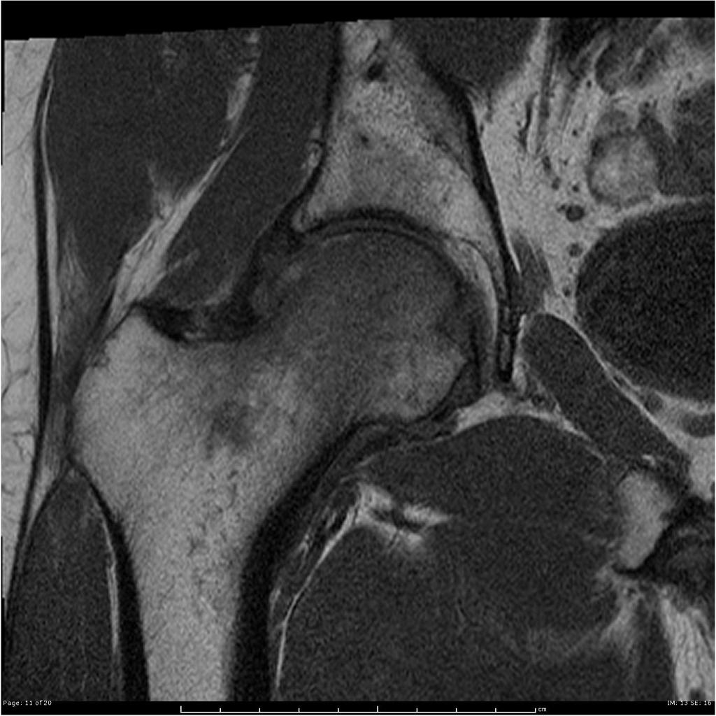 Coronal T1 Extensive marrow edema within the femoral head and neck. There is a subchondral fracture within the femoral head.