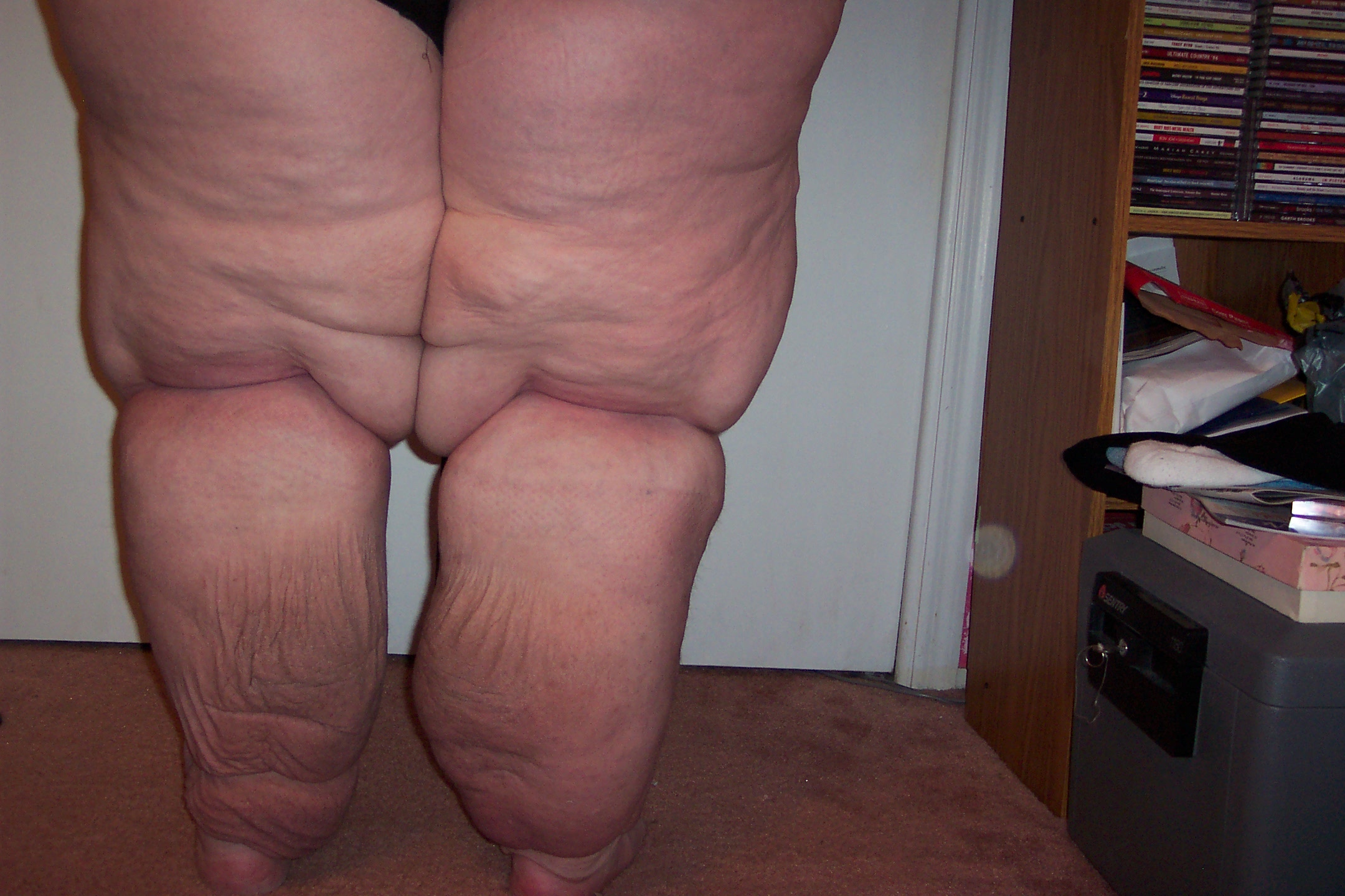 Stage 3 lymphedema back view after treatments, 65 pounds lost in 14 days