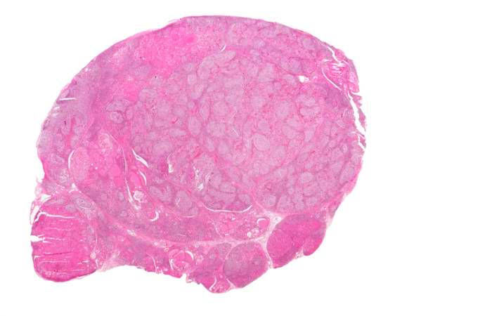 This is a low-power photomicrograph of thyroid from this case. Note that the tissue is more cellular than one would expect and there does not appear to be normal colloid-filled blue spaces in this gland.