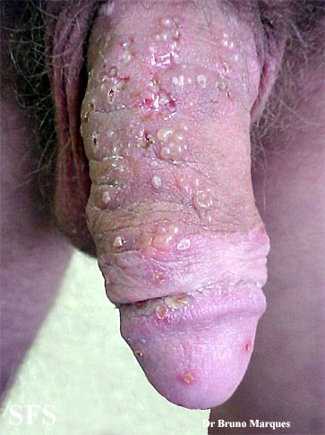 File:Herpes simplex 23.jpeg