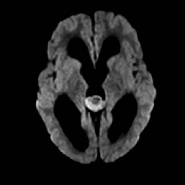 MRI image of pineoblastoma demonstrating restricted diffusion on DWI.[18]