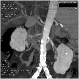 File:Renal artery stenosis 045.jpg
