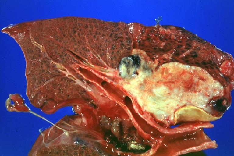 Lung: Carcinoma: Gross natural color good photo of left upper lobe neoplasm extending into mediastinal pleura and surrounding portion of aorta node metastasis easily seen small cell carcinoma (unusual spindle cell areas)