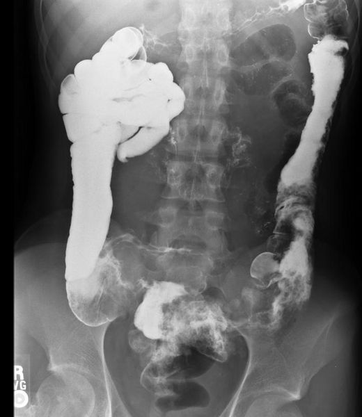 Active Crohn's disease small bowel series