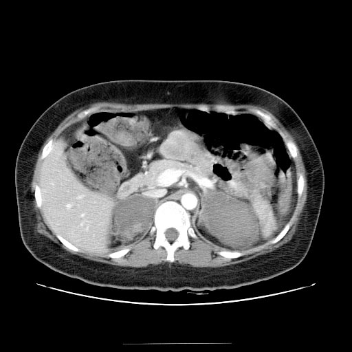 Computed Tomography: Bilateral adrenal hemorrhage