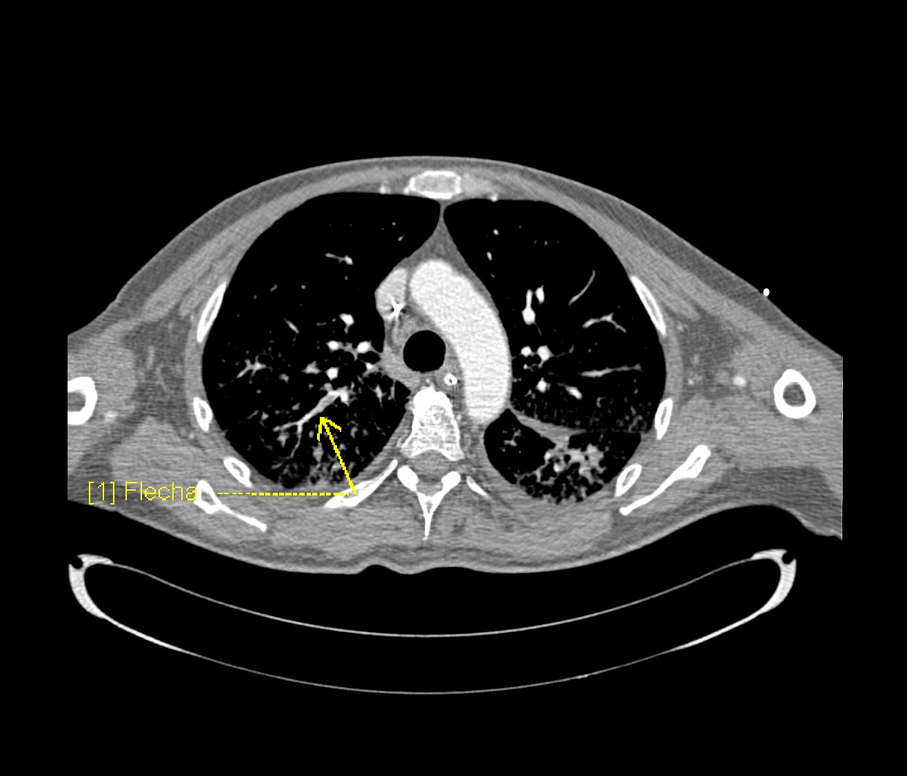 File:Covid-19-pneumonia-and-pulmonary-emboli.jpg