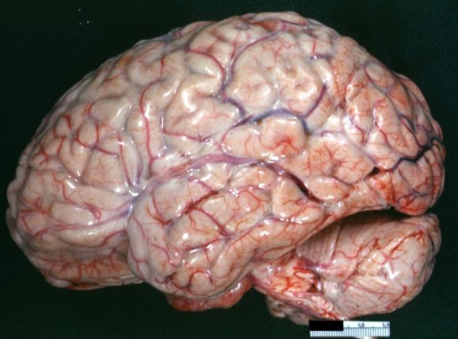 Purulent Meningitis: Gross natural color excellent photo lateral aspect of brain with easily seen purulent exudate due to Pneumococcus infection.