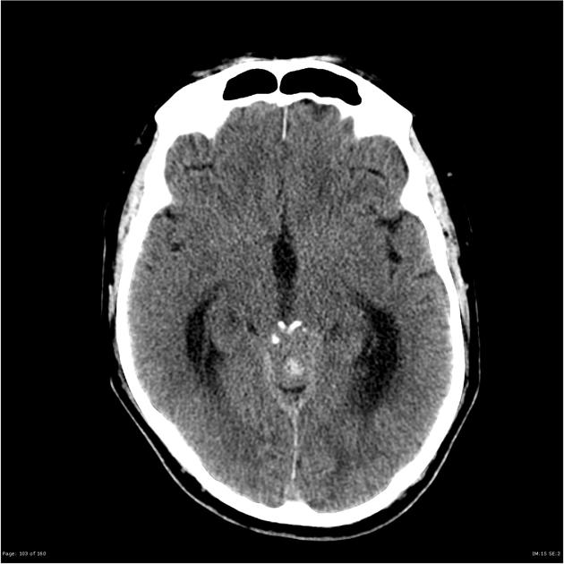 Pre-contrast CT scan demonstrating moderate internal obstructive hydrocephalus, due to a large, partially calcified, dense mass which appears to be centered upon the pineal gland. The quadrigeminal plate appears anteriorly displaced and the aqueduct obliterated. It does not appear to have an intimate relationship with the tentorium.[14]