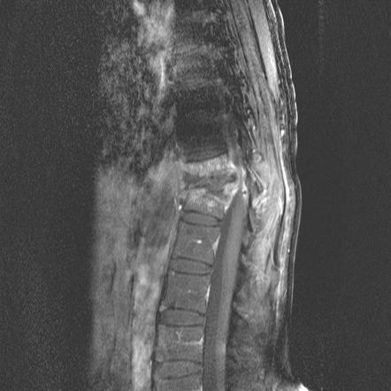 File:Spinal TB MRI 3.jpg