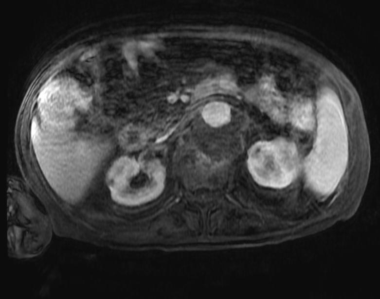 File:Tuberculosis paraspinal abscess MRI 002.jpg