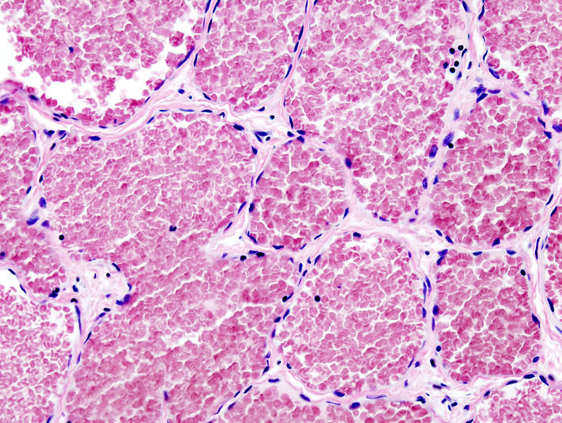 Histopathological image reprsenting a cavernous hemangioma of the liver. H&E stain.[2]