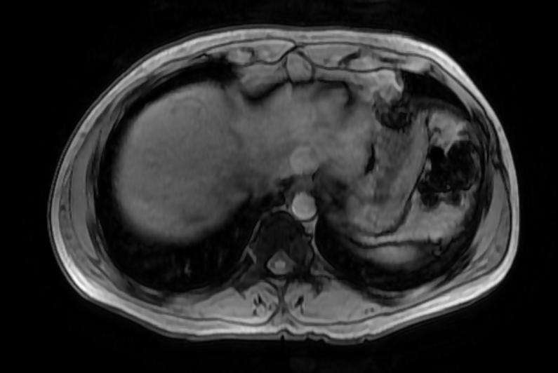 File:Focal nodular hyperplasia MRI 102.jpg