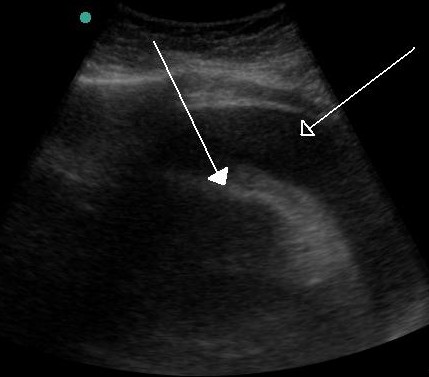 A very large hemorrhagic pericardial effusion due to malignancy as seen on ultrasound. closed arrow: the heart, open arrow: the effusion