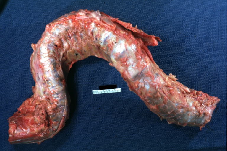 Bone, vertebra: Kyphoscoliosis: Gross natural color excised spinal column grossly deformed