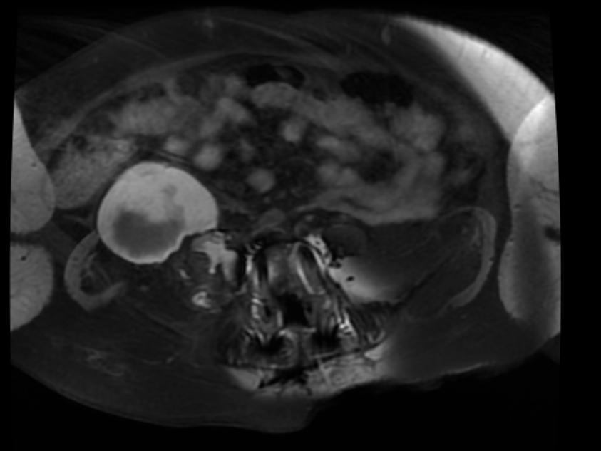 File:Retroperitoneal hematoma MRI 002.jpg