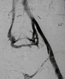 An occluded vein with collateral vessel formation. Source
