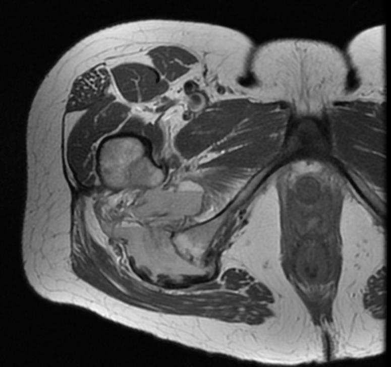 File:Hamstring tendon avulsion MRI 004.jpg